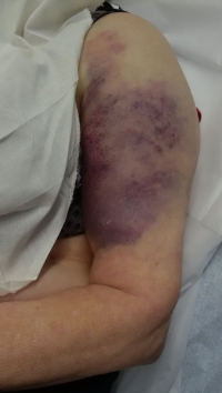 Proximaler Oberarmbruch1