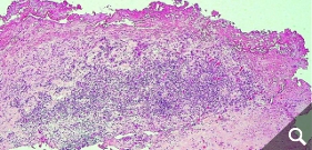 Diffuse Lymphozyteninfiltration in der Gelenkkapsel Diffuse Lymphozyteninfiltration in der Gelenkkapsel