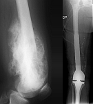 tumor1 tumor1