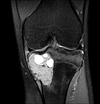 tumor2 tumor2