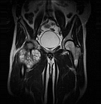 tumor3 tumor3