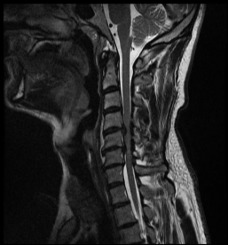 Spinalkanalstenose II Spinalkanalstenose II