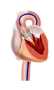 Implantat 2 Implantat 2